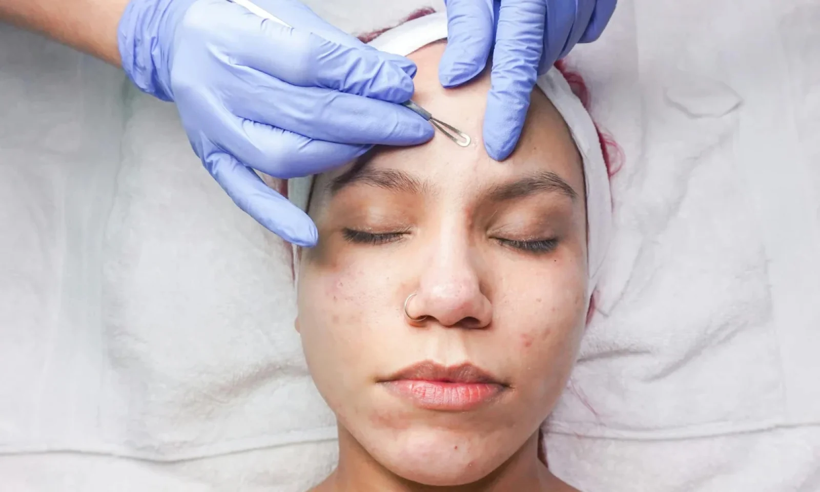 पिंपल्स हो रहे है बार बार तो हो जाए सावधान जानें इसके कारण और इन्हें ठीक करने के उपाय