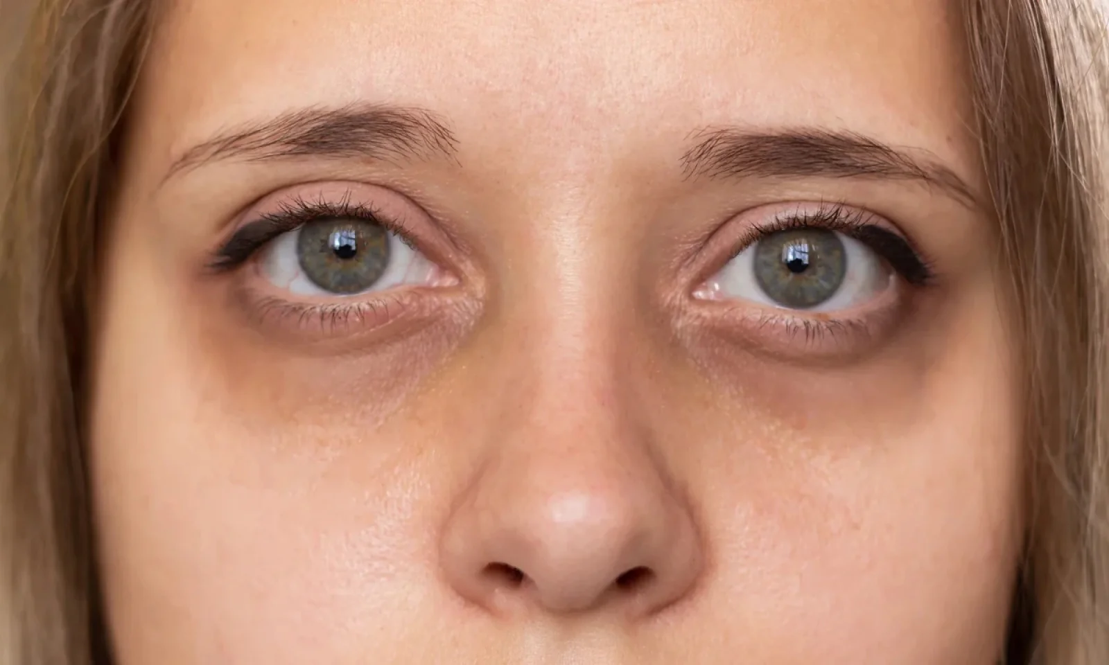 सर्दियों में डार्क सर्कल्स से पाएं छुटकारा जानें आसान घरेलू उपाय