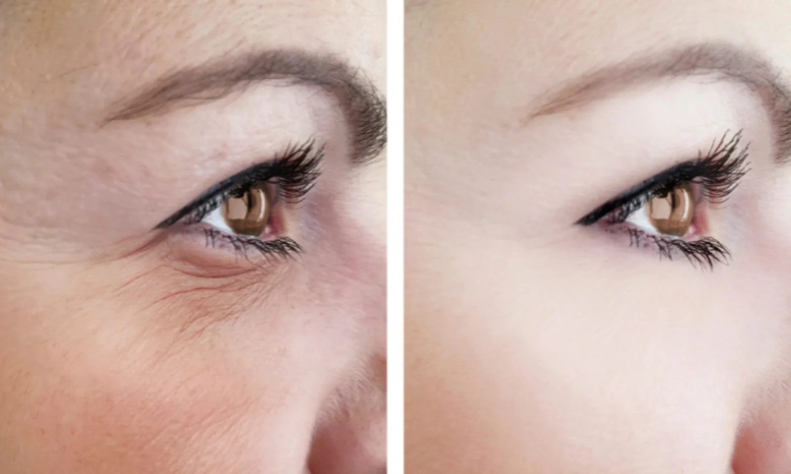 क्या आप भी Eye Wrinkles से है परेशान जानें इसके कारण और ट्रीटमेंट